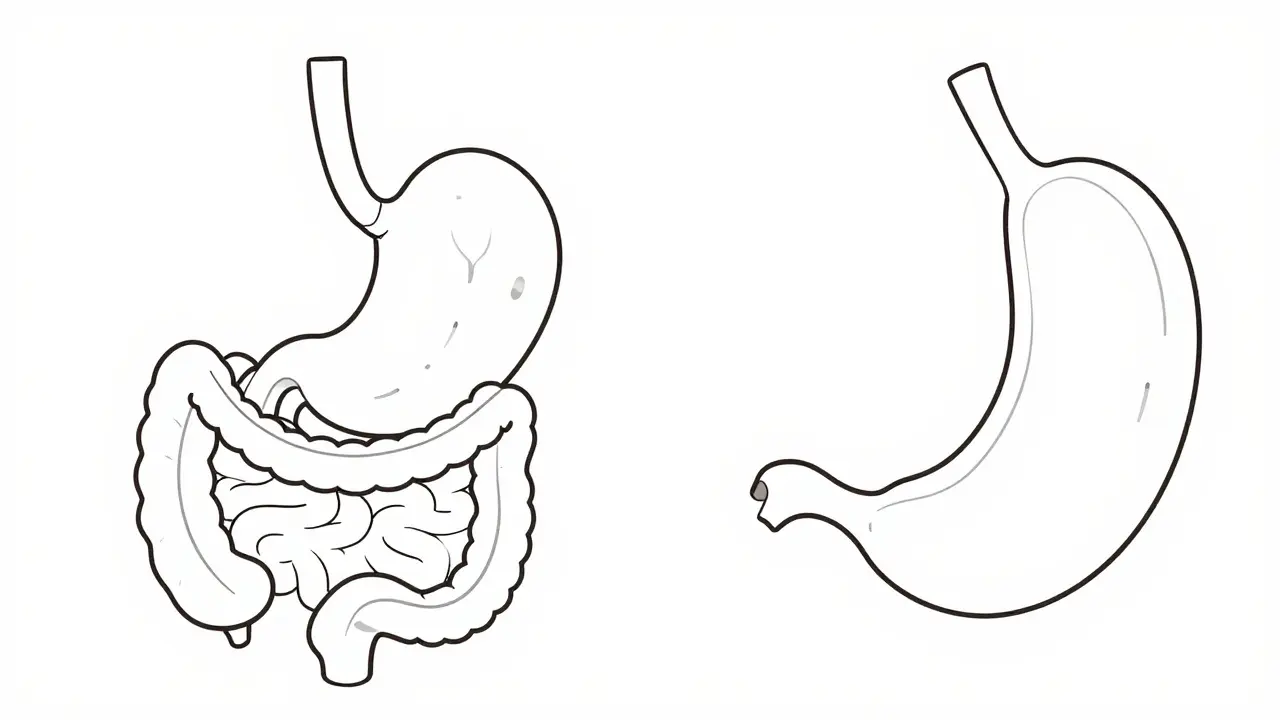 Chirurgie bariatrique : bypass gastrique vs gastrectomie en manchon